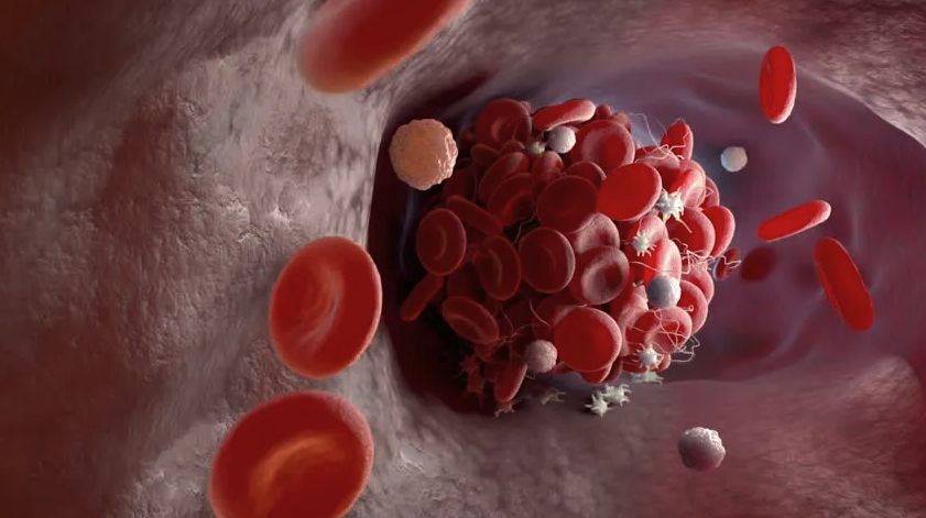Thrombosis Blood cells_Free to use Thrombosis Blood cells_Free to use